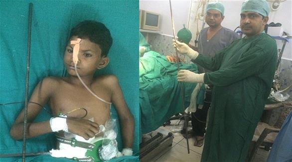 طفل هندي ينجو من الموت بعدما اخترق سيخ معدني ظهره