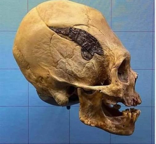جمجمة محارب بيروفي توثق أول جراحة في العالم منذ 2000 عام