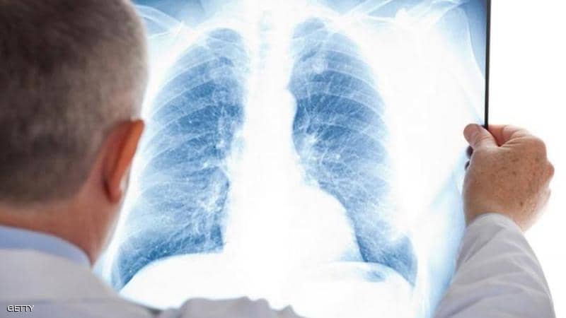 علماء صينيون يتوصلون لـ"علاج محتمل" لسرطان الرئة